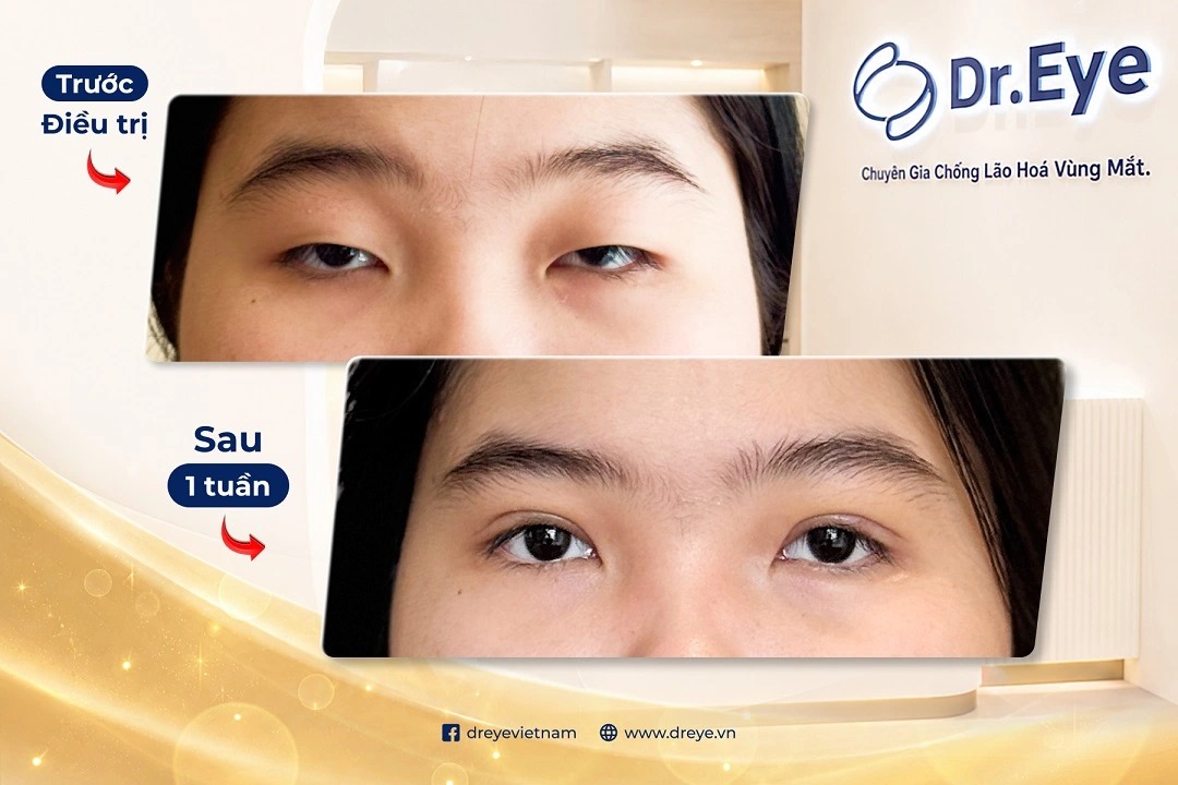 Trước và sau điều trị sụp mí tại Dr. Eye – BS CKII Nguyễn Thị Ly Na, chuyên sâu thẩm mỹ vùng mắt TP.HCM